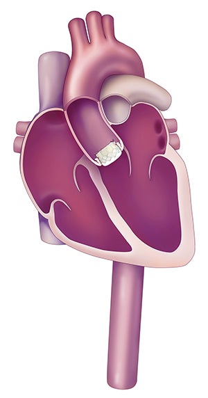 TAVR