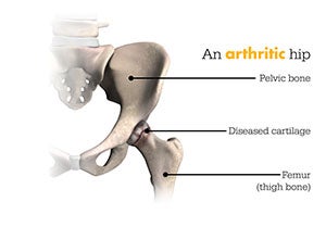 Arthritic hip