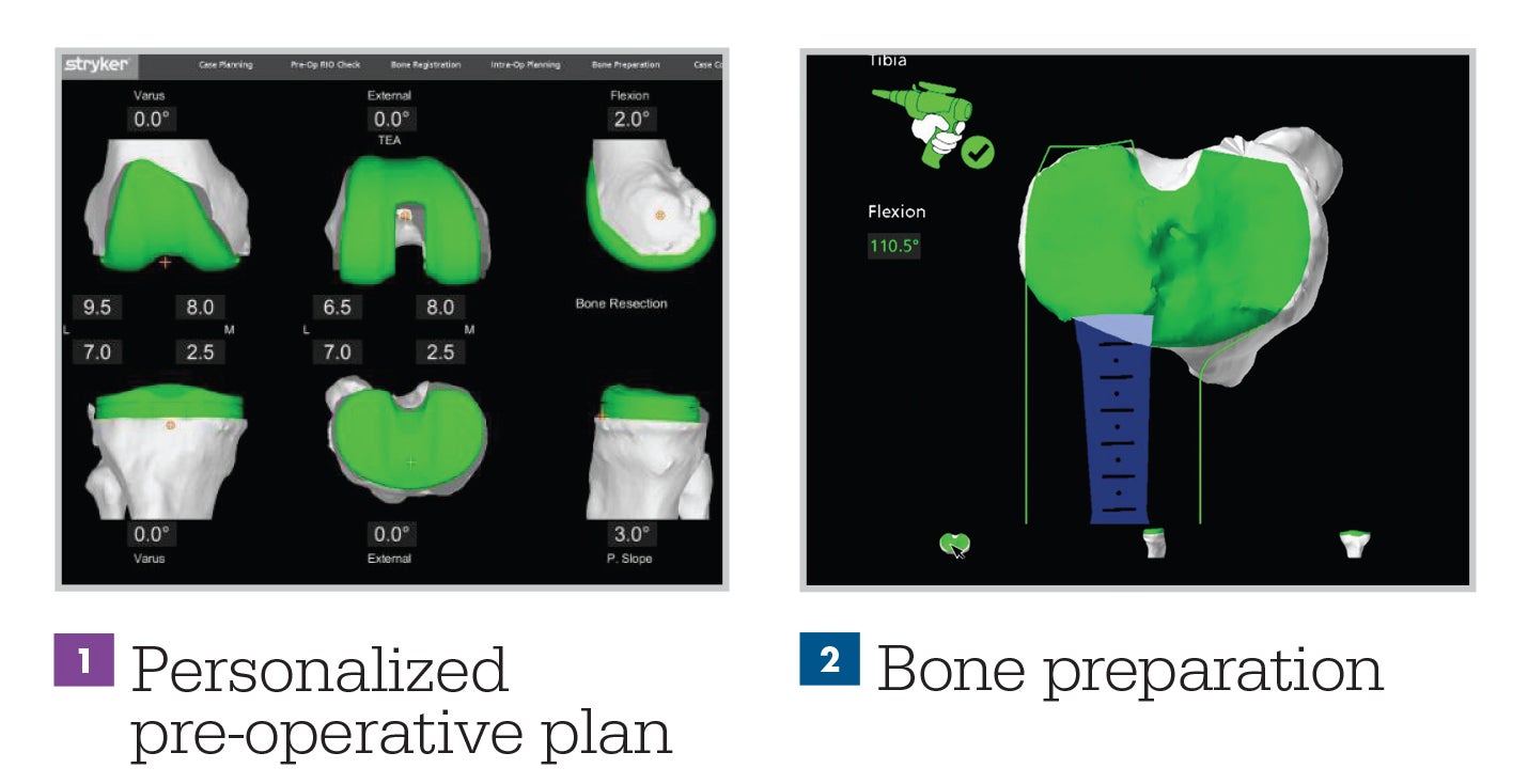 Total Knee Replacement